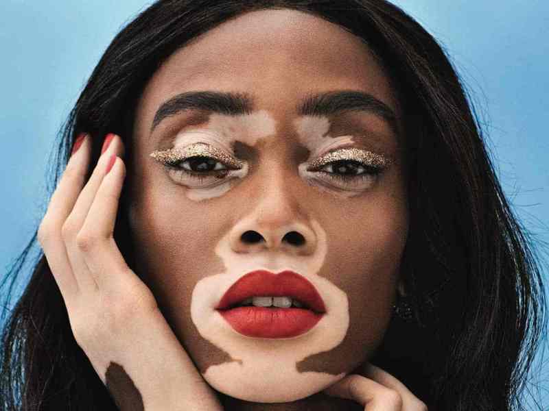    Une journée dédiée au vitiligo 

