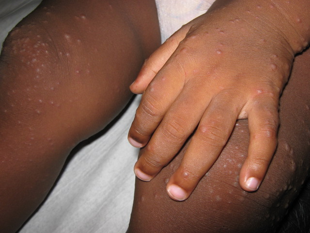     Le syndrome pieds-mains-bouche circule et touche de nombreux enfants en Martinique

