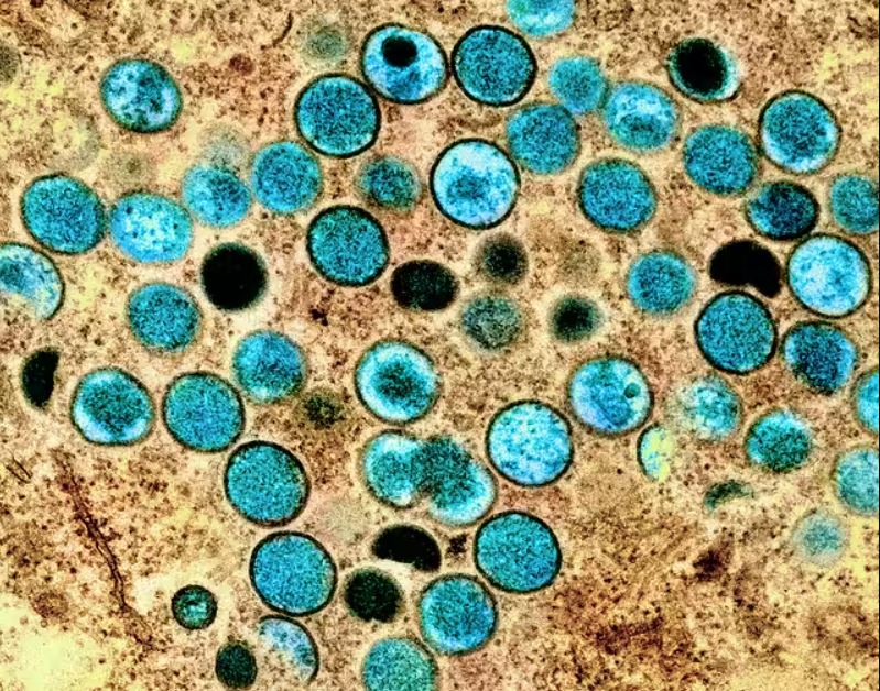     6 cas de variole du singe suspectés à Sainte-Lucie

